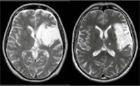 Lesion Left Brain Hemisphere