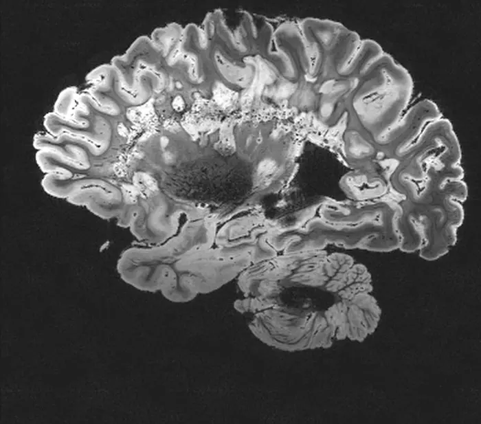 MRI scans are instrumental in the study of neuromyelitis optica spectrum disorder