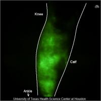 Lower Leg Lymphedema