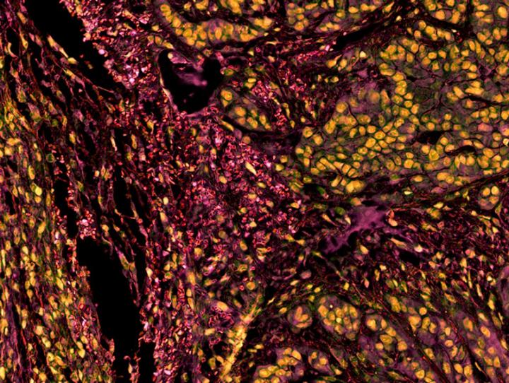 Purdue University Tumor Technology