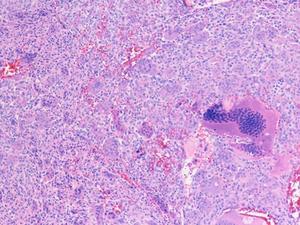 Modulating the Unfolded Protein Response pathway may counter cancer-associated bone weakness