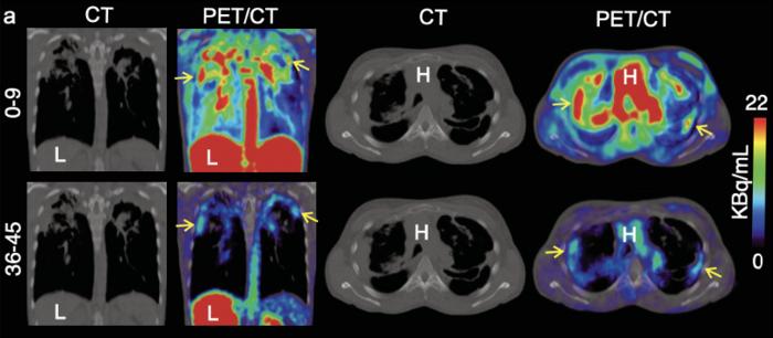 Representative coronal (left) and transverse (right) CT and 11C-PABA PET/CT images from a 33-year-old female with cystic fibrosis and confirmed M. abscessus infection in a 45-minute dynamic PET scan after an intravenous injection of 518 MBq of 11C-PABA.