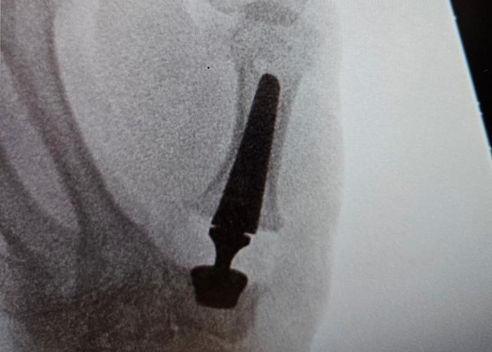 X-ray showing Thumb Implant