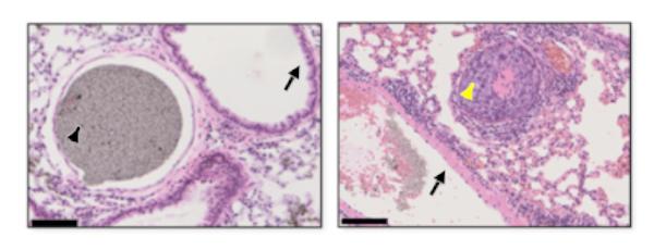 Inadequacies in Current Early-stage Lung Cancer Treatment Revealed