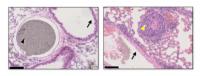 Inadequacies in Current Early-stage Lung Cancer Treatment Revealed