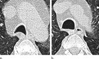 Weight Loss Surgery Improves Breathing Issues in Obese Patients