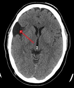 Cyst Formation in Brain