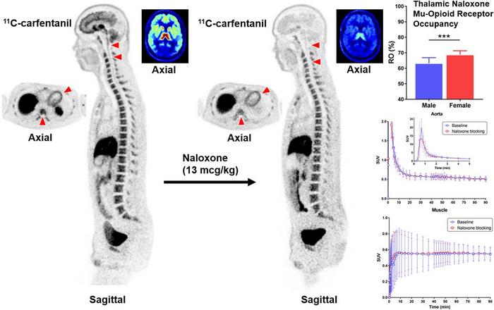 Whole-body [11C] carfentanil PET imaging at baseline and then following naloxone