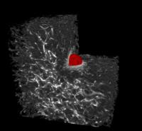 Melanoma Cell