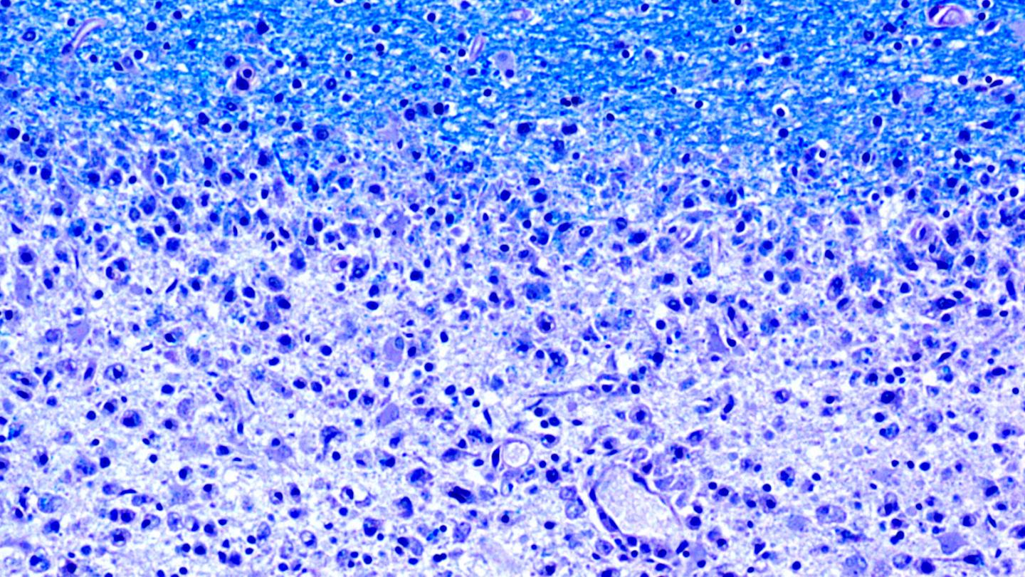 Diminishing Myelin Sheaths