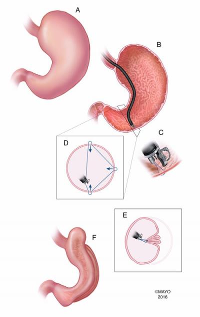 Endoscopic Sleeve Gastroplasty