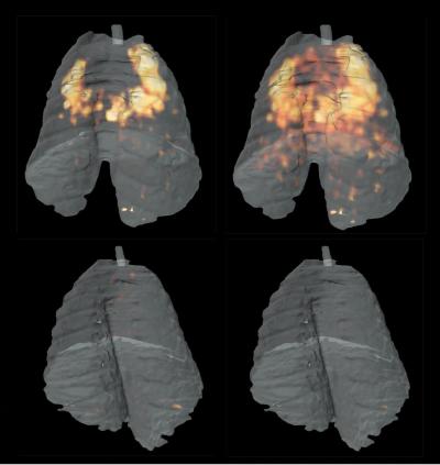 Research on Improvements in Diagnosing and Treating Tuberculosis (3 of 3)