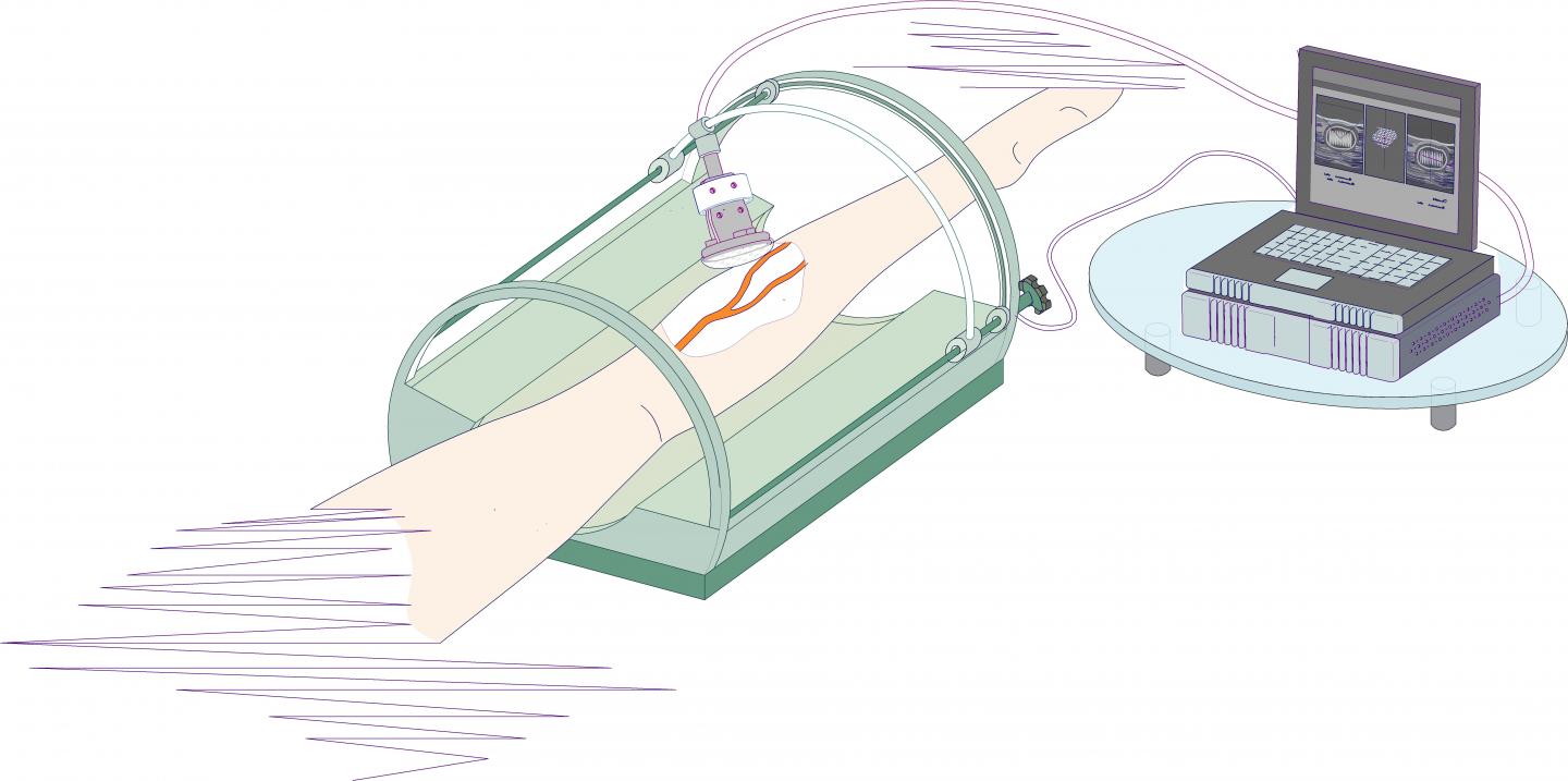 SPbPU Researchers Developed  New Technology of Varicose Veins Obliteration  by the Means of Focused 