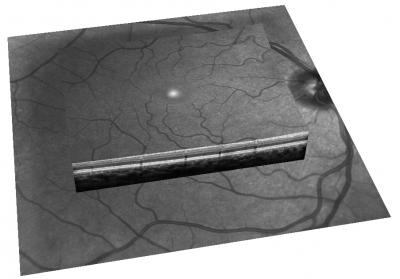 Restoring Eyesight with Gene Therapy (2 of 4)