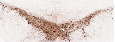 PD on Only One Side of the Brain