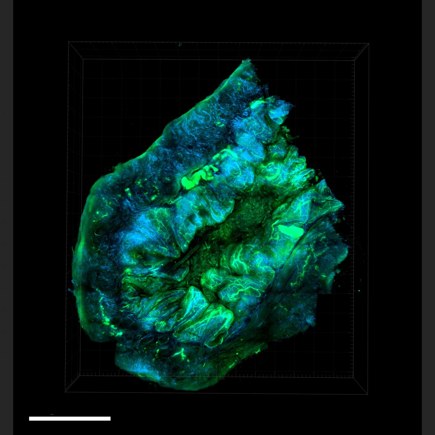 Ovarian Tumor