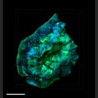Ovarian Tumor