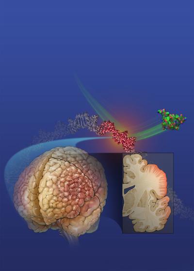 Novel Mutation Affects Brain-Folding Protein (2 of 4)