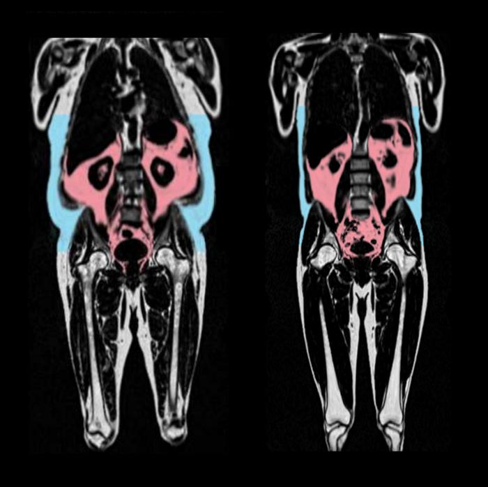 Body fat on MRI