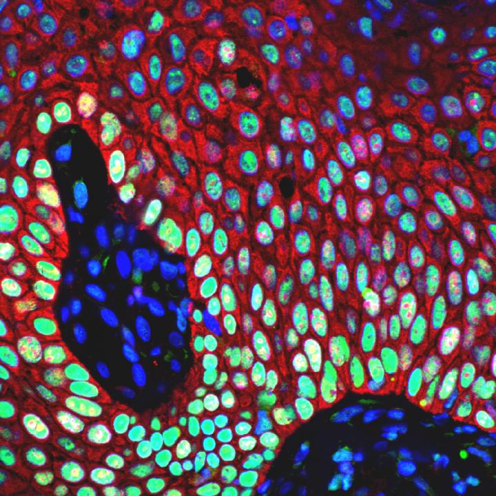 Lung Squamous Cell