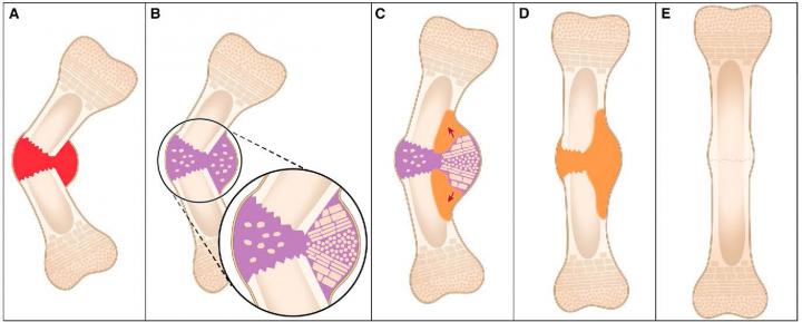 The Concept of Natural Reduction Expands the Traditional Four-Stage Classification of Fracture Healing