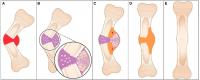 The Concept of Natural Reduction Expands the Traditional Four-Stage Classification of Fracture Healing
