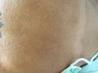 Physicians Publish Case Study of First Locally Acquired Zika Infection (2 of 2)