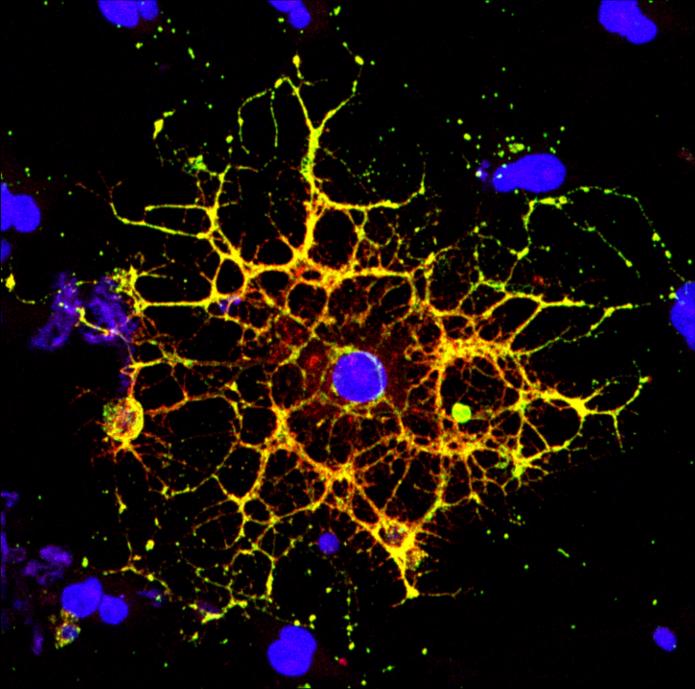 HIV and white matter in the brain