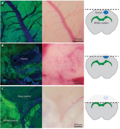 New Technique Rapidly Detects Brain Tumors (4 of 5)