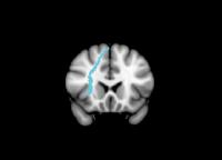 White Matter Tract
