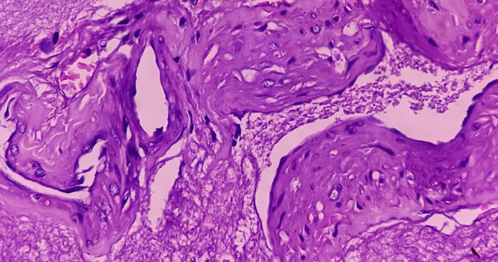 3D-Printed Kidney Tumours Show Potential for More Targeted Treatment
