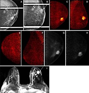 Images obtained in a 69-year-old female patient with a new biopsy-proven malignant lesion in the left breast.