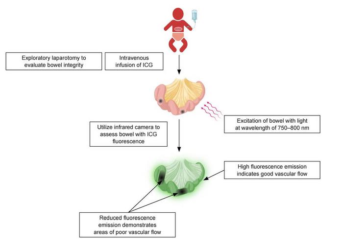 Utilization of indocyanine green fluorescence angiography (ICG-FA) for NEC.