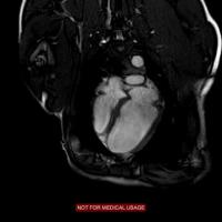 Cardiac MRI