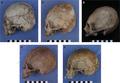 Cranial Modifications
