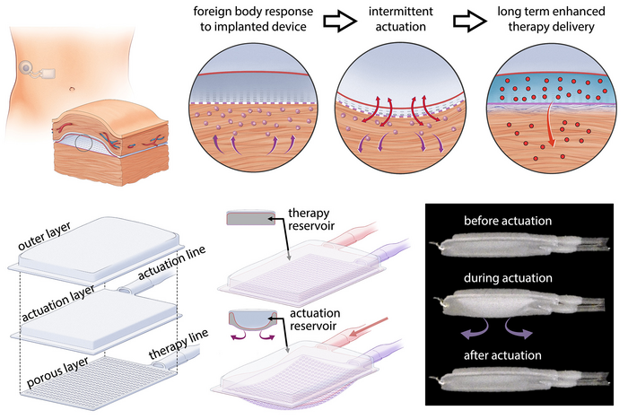 Drug-delivery system