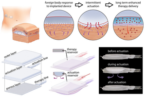 Drug-delivery system