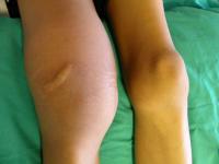 Hemophilia (2 of 2)
