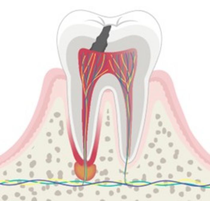 Engineered Self-Assembling Peptide for Biomimetic Dentin Hypersensitivity