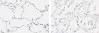 SARS Virus Promotes Fibrosis in Lung Cells