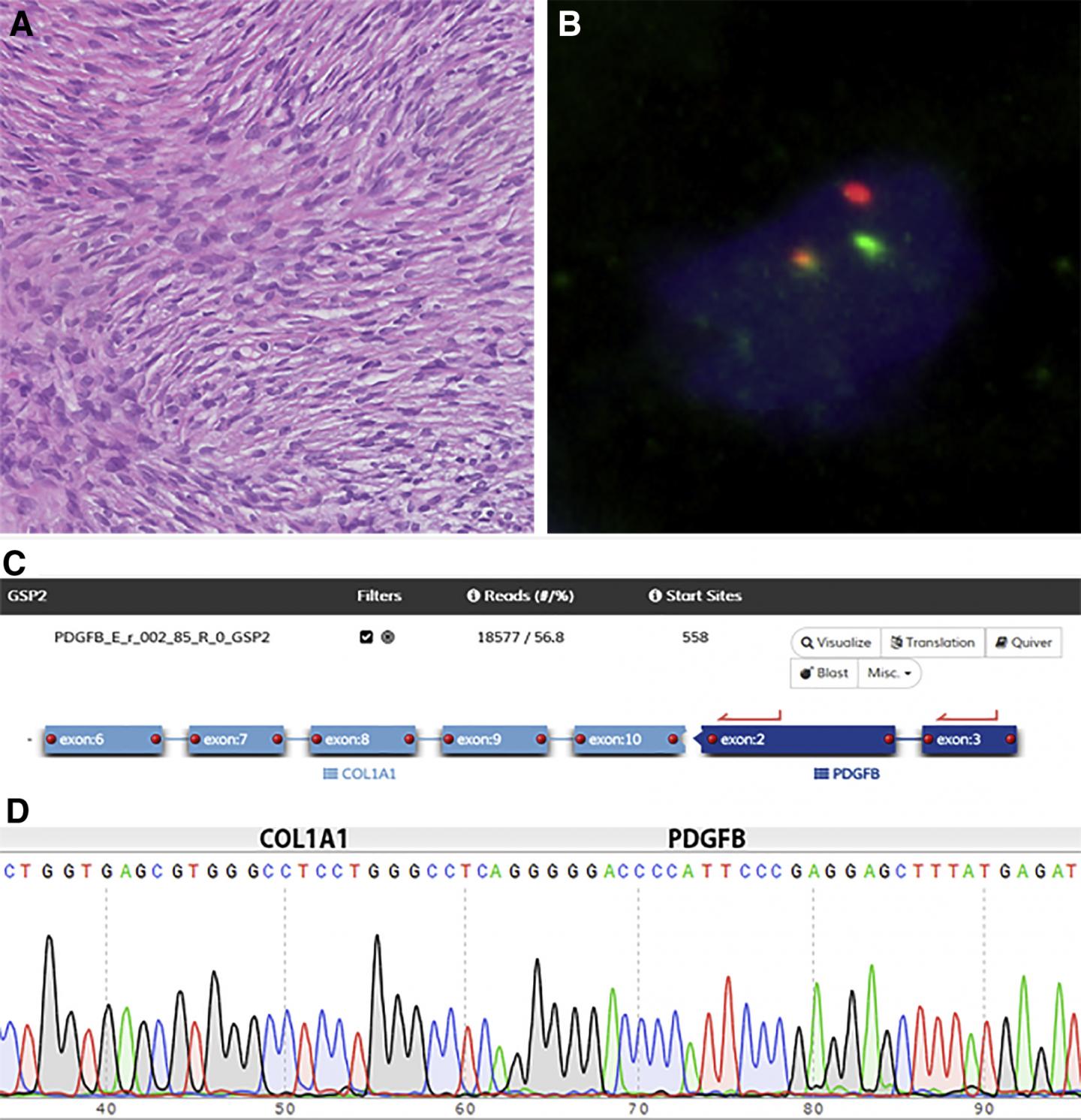 New Assay to Detect Genetic Abnormalities in Sarcomas Outperforms Conventional Techniques