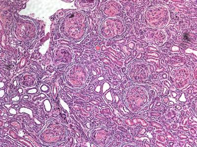 New Clues to Lupus Development (2 of 3)