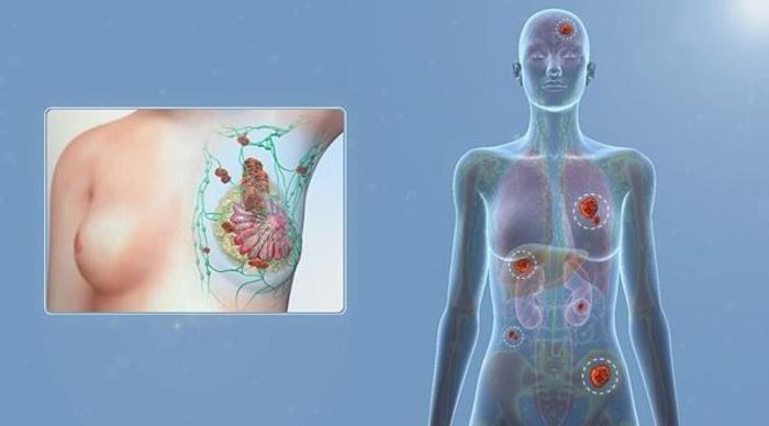 Breast Cancer and Metastasis