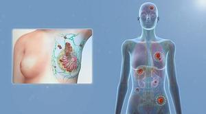 Breast Cancer and Metastasis