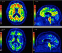 PET and MRI Feature Scan