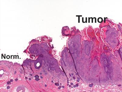 New Skin Cancer Model