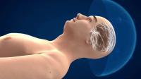 Animation of Noninvasive Ultrasound Neurosurgery