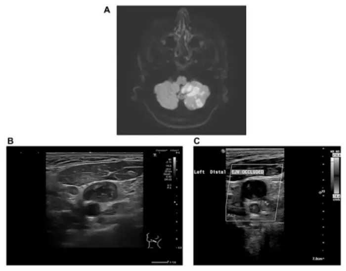 When strokes reveal a hidden malignancy: An atypical case of metastatic colorectal cancer with extensive thromboembolism