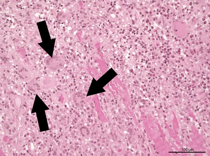 Detecting and treating diseased heart muscles as effectively as possible