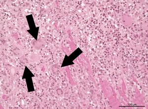 Detecting and treating diseased heart muscles as effectively as possible